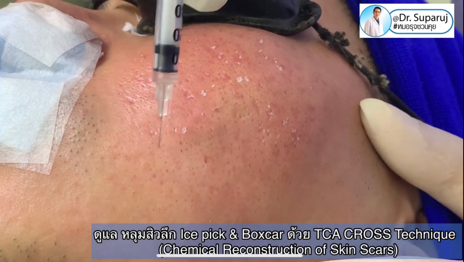 รักษาหลุมสิวด้วยการแต้มกรด TCA แล้วเกิดเป็นรอยดำ เกิดจากอะไรได้บ้าง? รักษาหลุมสิวด้วยการแต้มกรด TCA แล้วเกิดเป็นรอยดำ เกิดจากอะไรได้บ้าง?