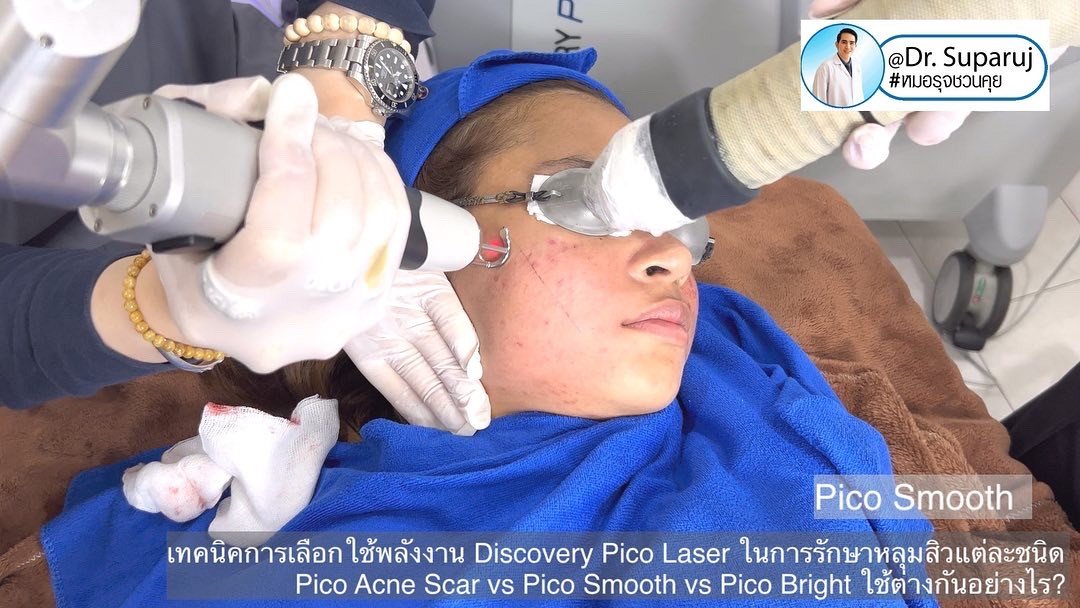 แนะนำเทคนิครักษาหลุมสิว: หัวยิงพิเศษรักษาหลุมสิว Fractional MLA 8 mm. ของ Discovery Pico Laser แนะนำเทคนิครักษาหลุมสิว: หัวยิงพิเศษรักษาหลุมสิว Fractional MLA 8 mm. ของ Discovery Pico Laser