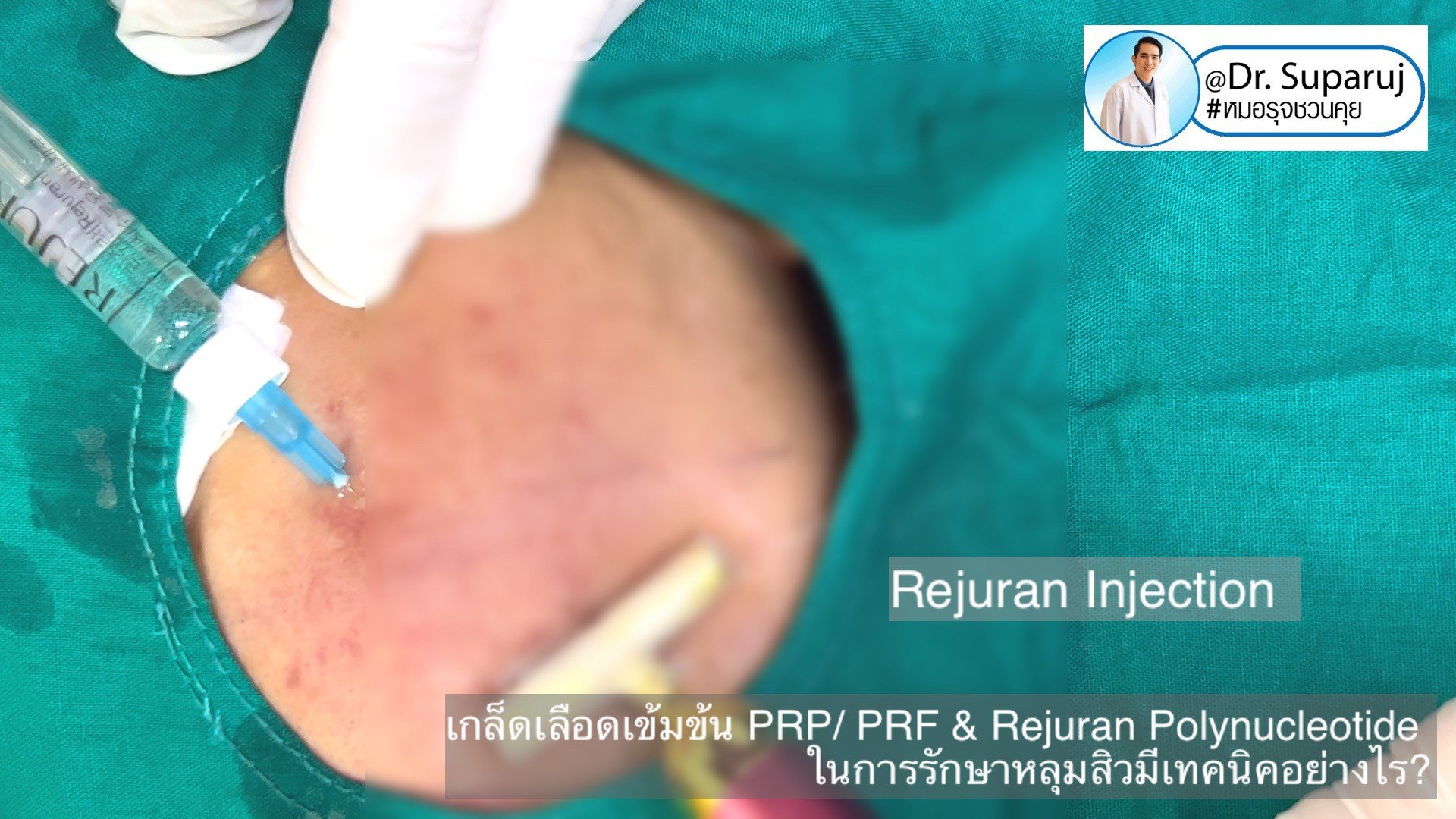 Update เทคนิคดูแลหลุมสิวด้วย Rejuran และ เกล็ดเลือดเข้มข้น PRP/PRF มีเทคนิคอย่างไร? เทคนิคไหนได้ผลดีกว่า ? Update เทคนิคดูแลหลุมสิวด้วย Rejuran และ เกล็ดเลือดเข้มข้น PRP/PRF มีเทคนิคอย่างไร? เทคนิคไหนได้ผลดีกว่า ?