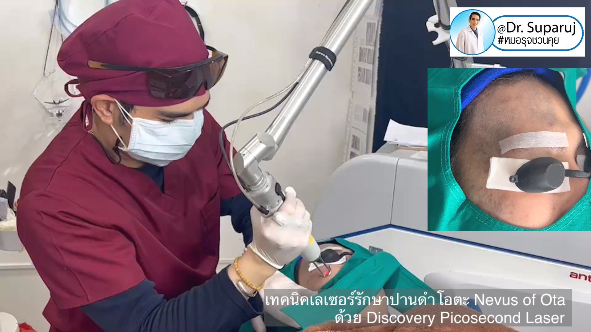 เทคนิคเลเซอร์รักษาปานดำโอตะ Nevus of Ota ด้วย Discovery Picosecond Laser เลเซอร์ปานดำ l หมอรุจชวนคุย เทคนิคเลเซอร์รักษาปานดำโอตะ Nevus of Ota ด้วย Discovery Picosecond Laser เลเซอร์ปานดำ l หมอรุจชวนคุย