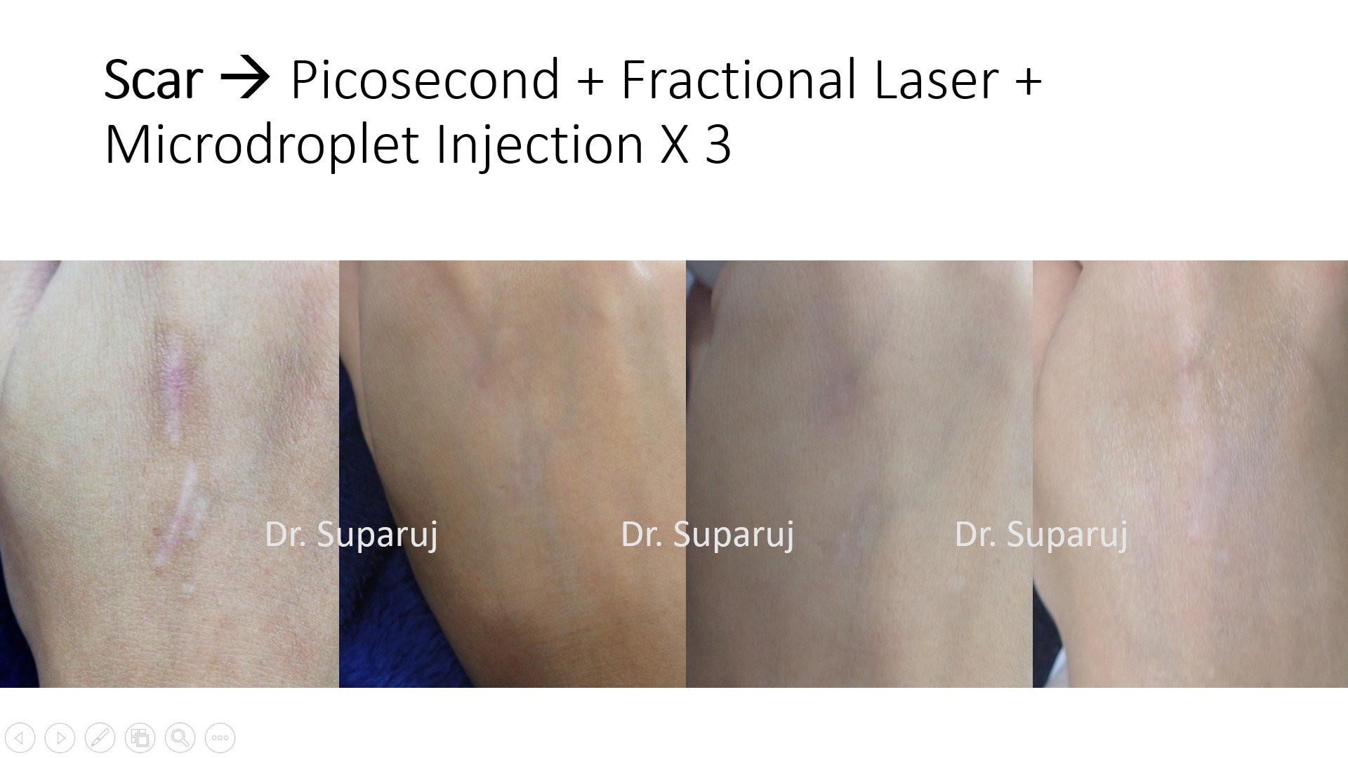 เทคนิคดูแลแผลเป็นนูน คีลอยด์ Keloid ด้วยเลเซอร์ Triple Laser Therapy: Picosecond + Gold Toning + Fractional Laser เทคนิคดูแลแผลเป็นนูน คีลอยด์ Keloid ด้วยเลเซอร์ Triple Laser Therapy: Picosecond + Gold Toning + Fractional Laser