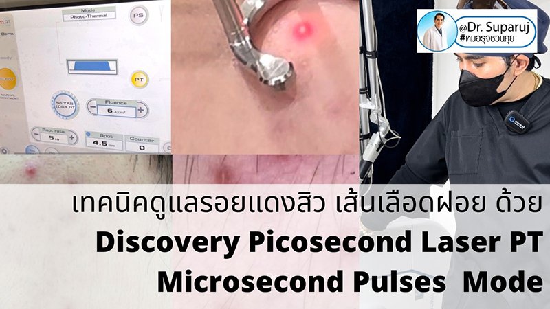 แนะนำเทคนิคดูแลรอยแดงสิว เส้นเลือดฝอย : เทคนิครักษารอยแดงสิว เส้นเลือดฝอย ด้วย Discovery Picosecond Laser PT Microsecond Pulses Mode 