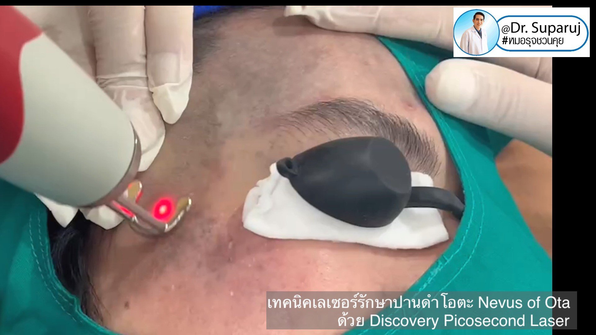 เทคนิคเลเซอร์รักษาปานดำโอตะ Nevus of Ota ด้วย Discovery Picosecond Laser เลเซอร์ปานดำ l หมอรุจชวนคุย