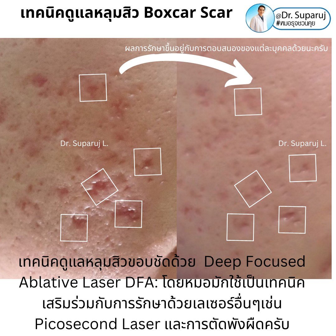 แนะนำเทคนิคดูแลหลุมสิว: เทคนิค Deep Focused Ablative Laser (DFA) ดูแลหลุมสิวลึกขอบชัดพังผืดหนา Boxcar Scar และหลุมสิวลักษณะเส้นยาว Linear scar