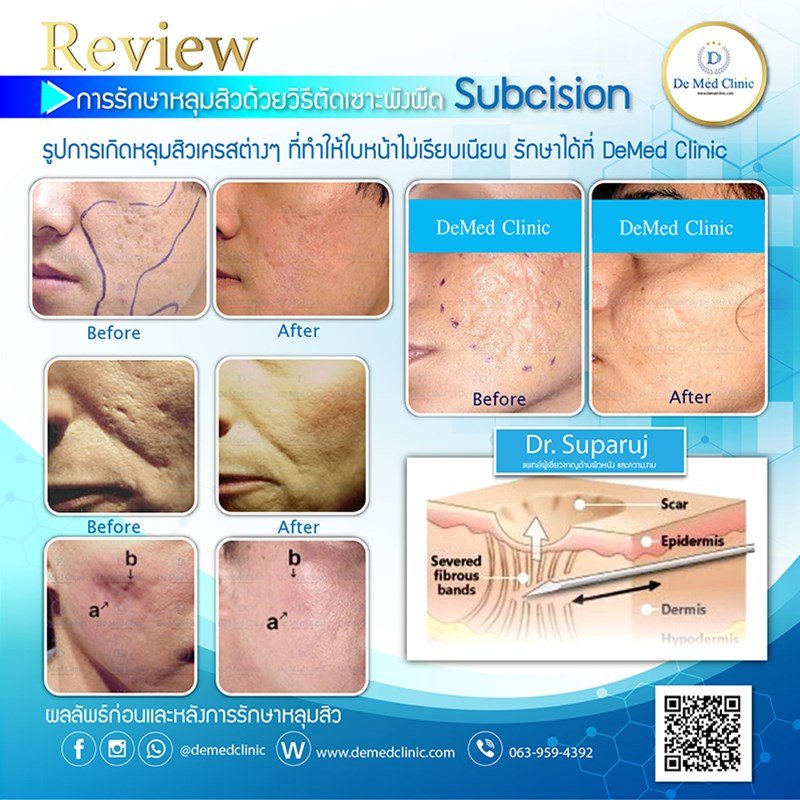 การรักษารอยแผลเป็นแบบหลุมจากสิว Atrophic Acne Scar ด้วยการผ่าตัด Scar Revision คืออะไร ? การรักษารอยแผลเป็นแบบหลุมจากสิว Atrophic Acne Scar ด้วยการผ่าตัด Scar Revision คืออะไร ?
