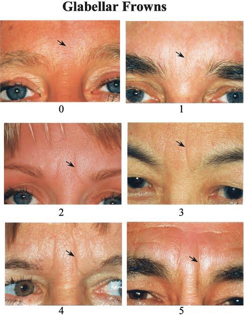 ร่องขมวดคิ้ว Gabellar Line ดูแลได้อย่างไร? ร่องขมวดคิ้ว Gabellar Line ดูแลได้อย่างไร?