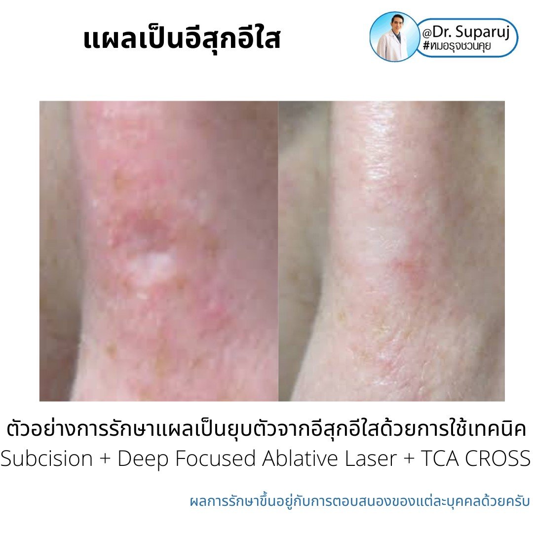 แผลเป็นยุบตัวจากอีสุกอีใส Chicken pox scars ดูแลได้อย่างไร ?