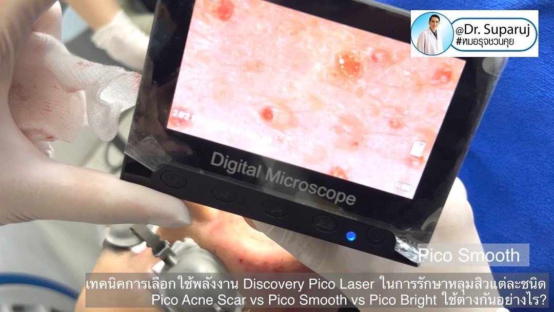 แนะนำเทคนิครักษาหลุมสิว: หัวยิงพิเศษรักษาหลุมสิว Fractional MLA 8 mm. ของ Discovery Pico Laser