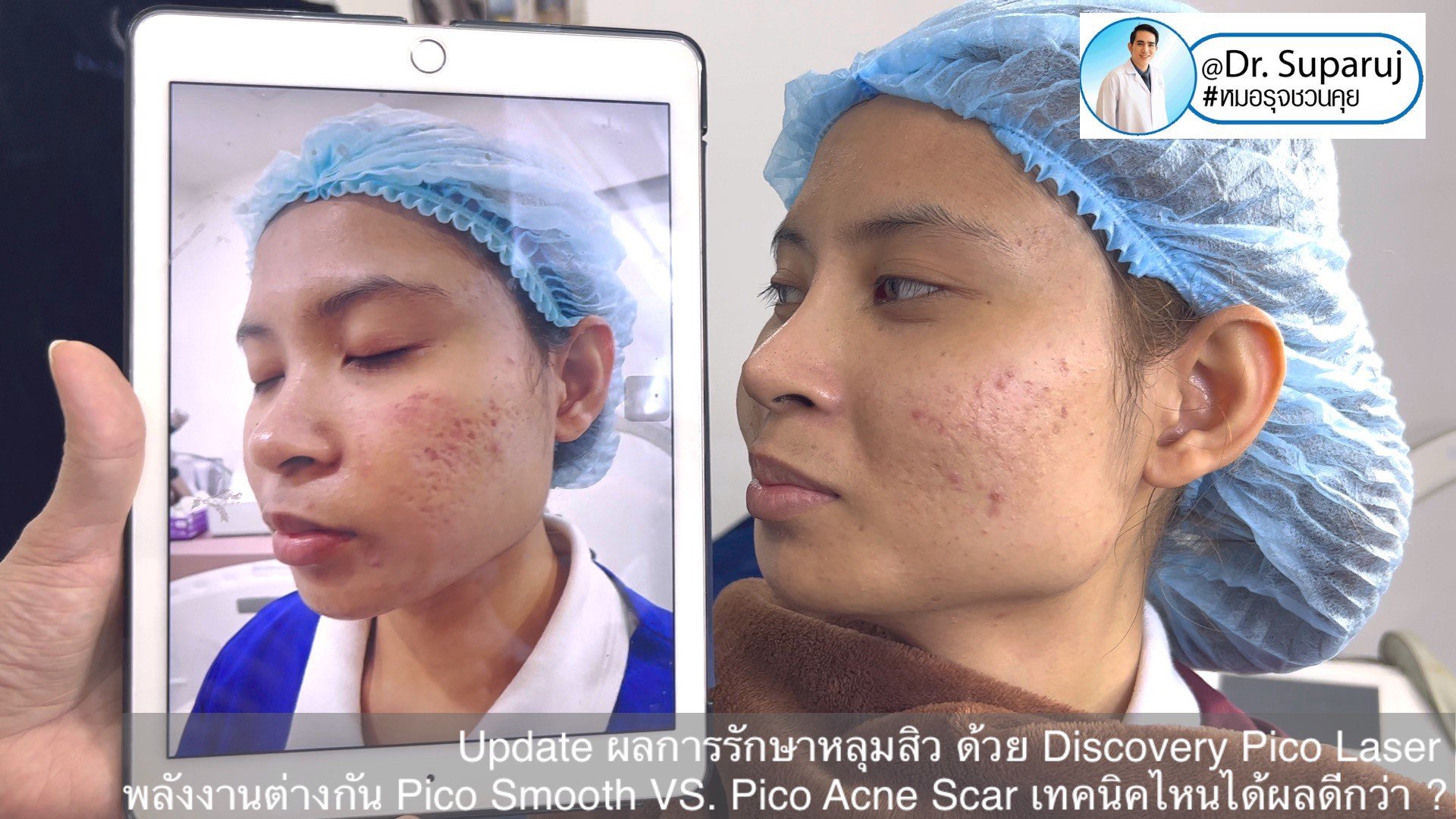 Update ผลการรักษาหลุมสิว ด้วย Discovery Pico Laser พลังงานต่างกัน Pico Smooth (Moderate Fluence) VS. Pico Acne Scar (High Fluence)เทคนิคไหนได้ผลดีกว่า ? Update ผลการรักษาหลุมสิว ด้วย Discovery Pico Laser พลังงานต่างกัน Pico Smooth (Moderate Fluence) VS. Pico Acne Scar (High Fluence)เทคนิคไหนได้ผลดีกว่า ?