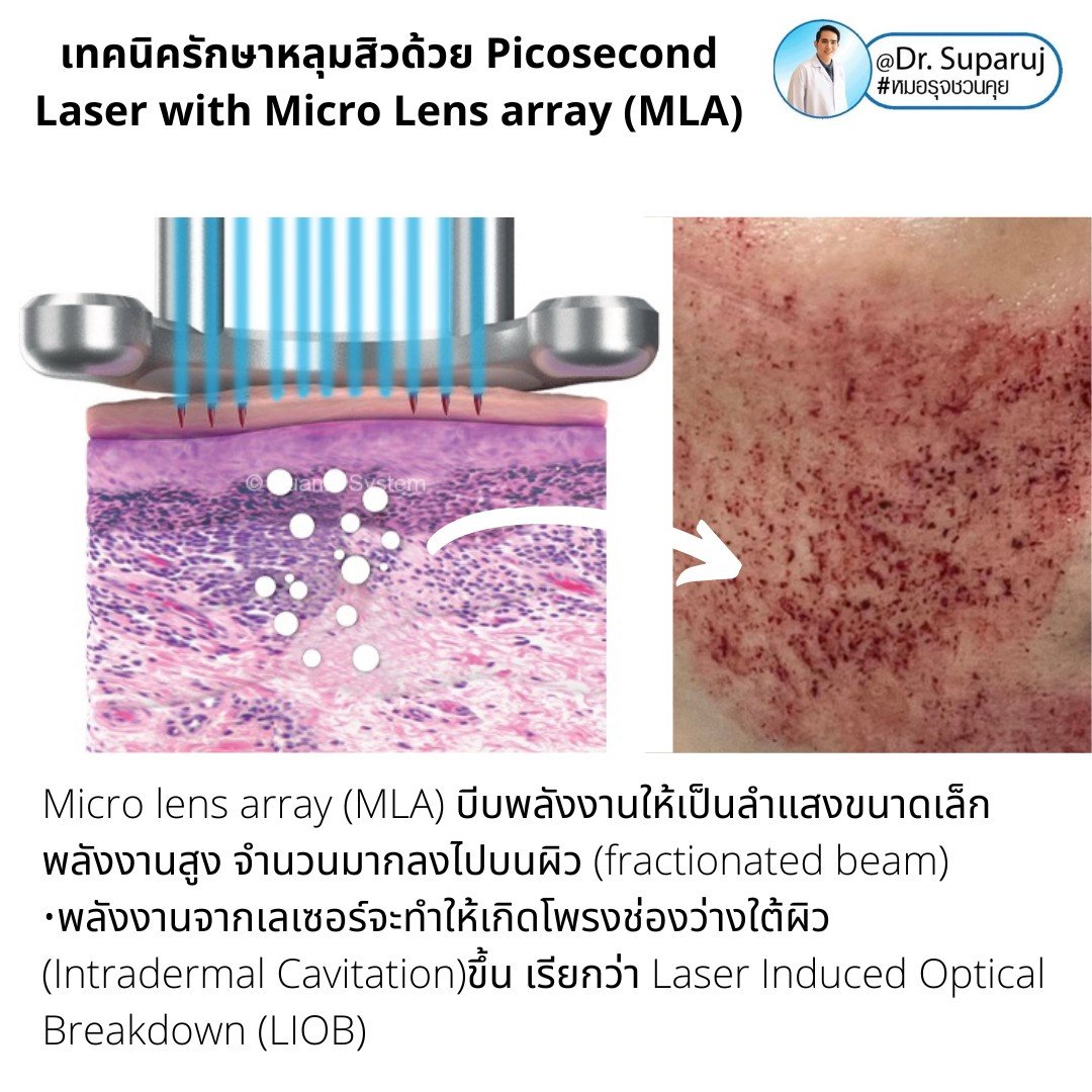 แนะนำเทคนิคดูแลหลุมสิว: Picosecond Laser แต่ละ Mode แตกต่างกันอย่างไร ? ใช้ดูแลปัญหาไหน ชนิดไหนดีกว่ากัน: Full Beam/ Fractional MLA ?/ High Fluence/ Low Fluence