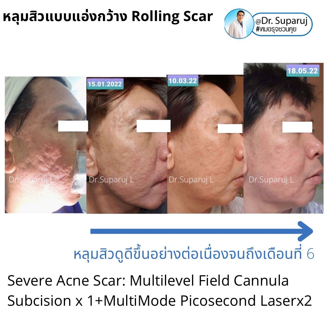 รักษาหลุมสิว ดูผลการรักษา ที่ระยะเวลาเท่าไหร่ดีที่สุด ? รักษาหลุมสิว ดูผลการรักษา ที่ระยะเวลาเท่าไหร่ดีที่สุด ?