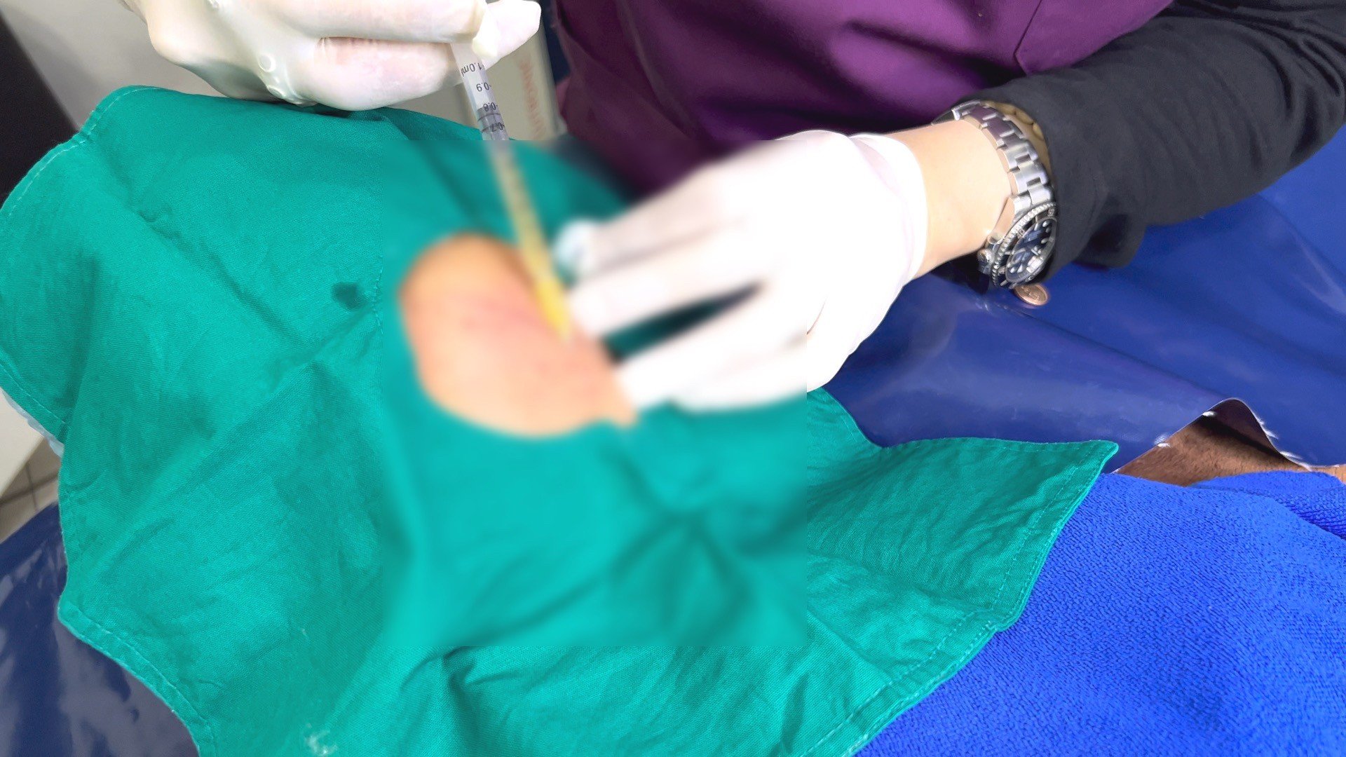 Update เทคนิคดูแลหลุมสิวด้วย Rejuran และ เกล็ดเลือดเข้มข้น PRP/PRF มีเทคนิคอย่างไร? เทคนิคไหนได้ผลดีกว่า ? Update เทคนิคดูแลหลุมสิวด้วย Rejuran และ เกล็ดเลือดเข้มข้น PRP/PRF มีเทคนิคอย่างไร? เทคนิคไหนได้ผลดีกว่า ?