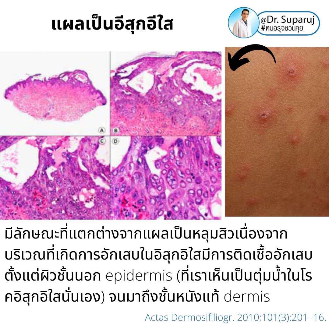 แผลเป็นยุบตัวจากอีสุกอีใส Chicken pox scars ดูแลได้อย่างไร ? แผลเป็นยุบตัวจากอีสุกอีใส Chicken pox scars ดูแลได้อย่างไร ?