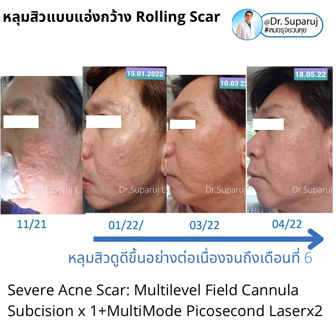 รักษาหลุมสิว ดูผลการรักษา ที่ระยะเวลาเท่าไหร่ดีที่สุด ? รักษาหลุมสิว ดูผลการรักษา ที่ระยะเวลาเท่าไหร่ดีที่สุด ?