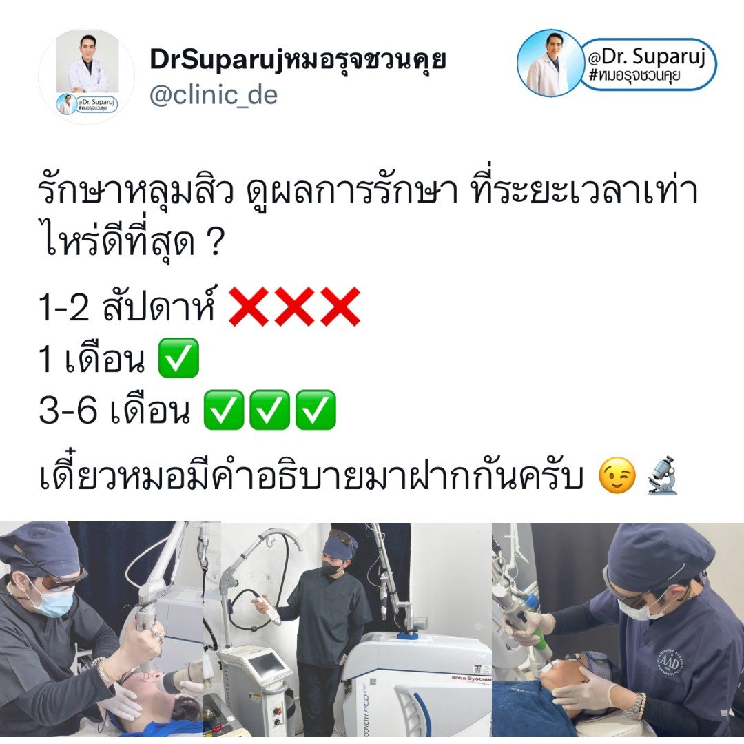 รักษาหลุมสิว ดูผลการรักษา ที่ระยะเวลาเท่าไหร่ดีที่สุด ?