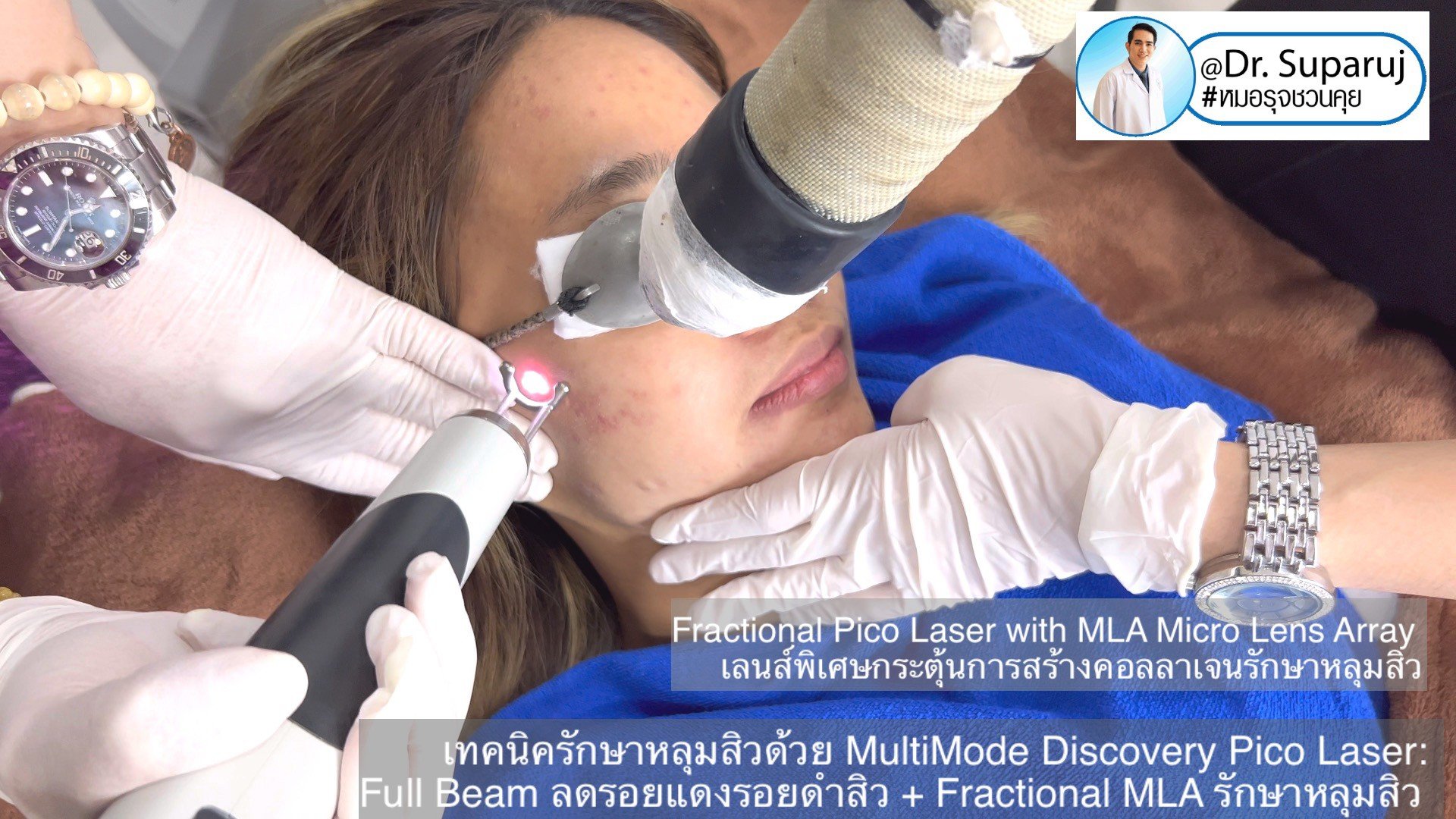 เทคนิครักษาหลุมสิวด้วย MultiMode Discovery Pico Laser: Full Beam ลดรอยแดงรอยดำสิว + Fractional MLA รักษาหลุมสิวครับ เทคนิครักษาหลุมสิวด้วย MultiMode Discovery Pico Laser: Full Beam ลดรอยแดงรอยดำสิว + Fractional MLA รักษาหลุมสิวครับ