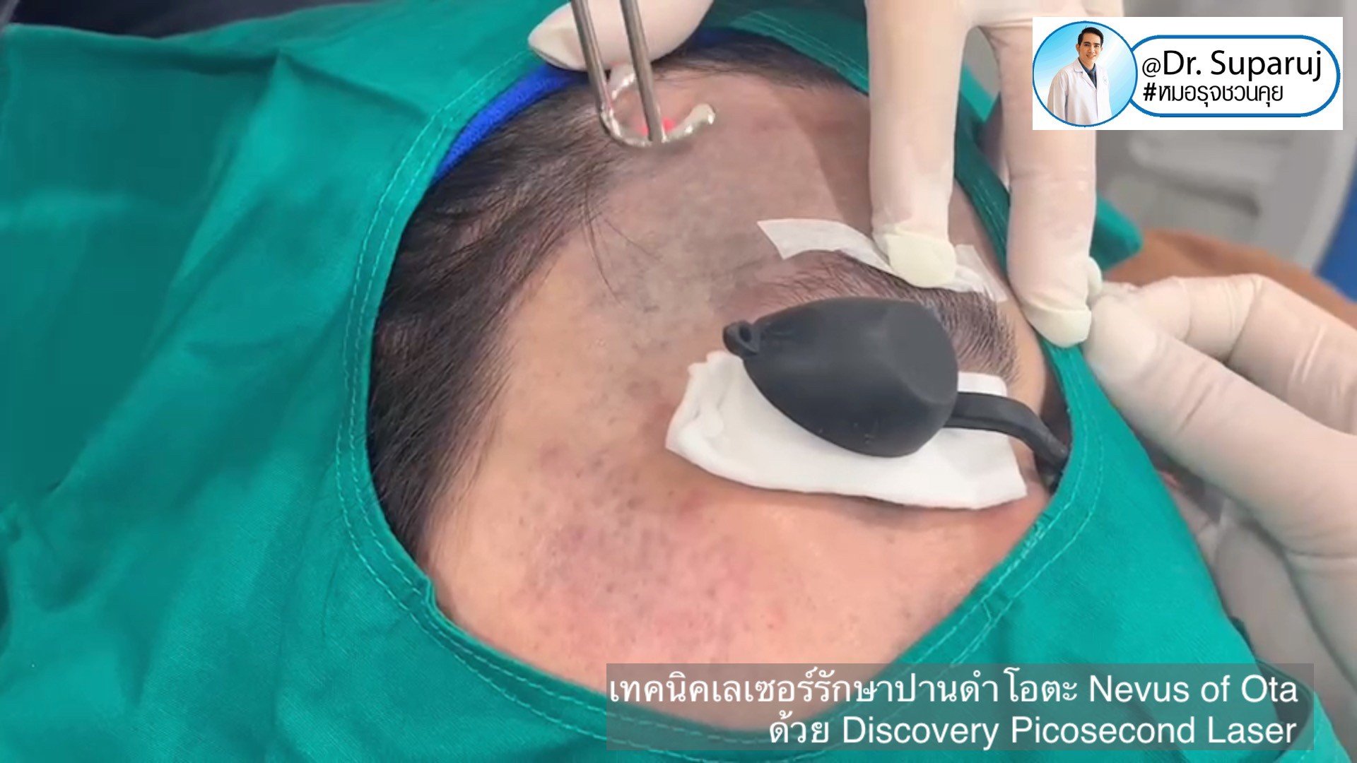 เทคนิคเลเซอร์รักษาปานดำโอตะ Nevus of Ota ด้วย Discovery Picosecond Laser เลเซอร์ปานดำ l หมอรุจชวนคุย