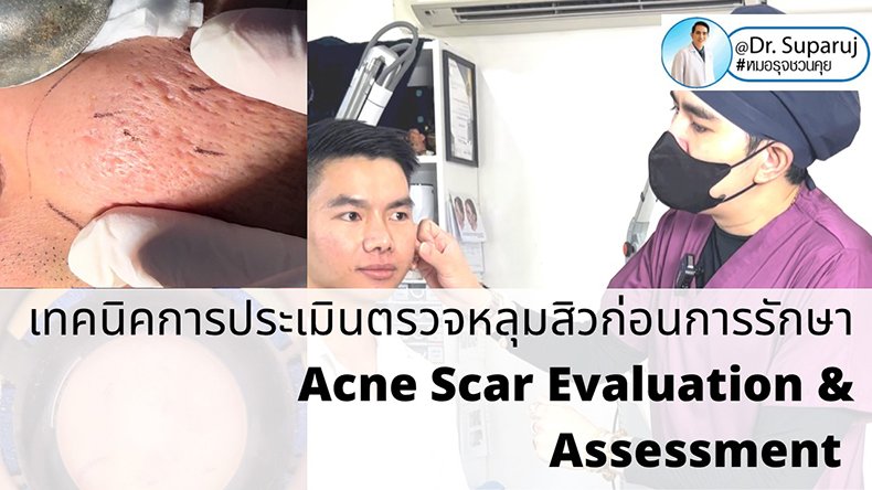 เทคนิคการประเมินตรวจหลุมสิวก่อนการรักษา Acne Scar Evaluation & Assessment