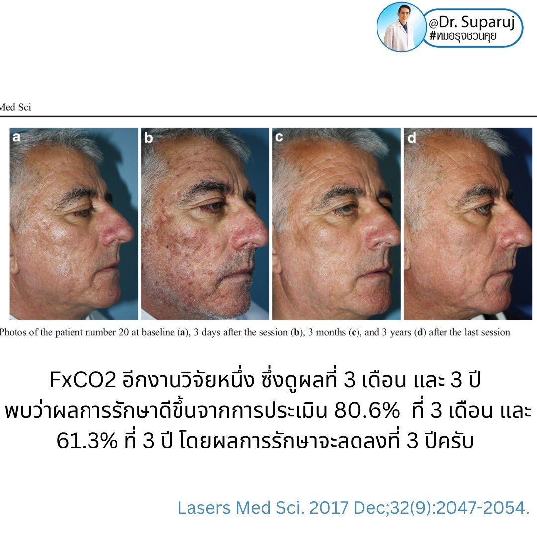 Q: หลังรักษาหลุมสิวด้วยเลเซอร์หรือเทคนิคต่างๆ หลังจากรักษาเรียบร้อยแล้ว จะมีโอกาสกลับมายุบตัว หรือหลุมสิวจะกลับมาแบบเดิมไหม? Q: หลังรักษาหลุมสิวด้วยเลเซอร์หรือเทคนิคต่างๆ หลังจากรักษาเรียบร้อยแล้ว จะมีโอกาสกลับมายุบตัว หรือหลุมสิวจะกลับมาแบบเดิมไหม?