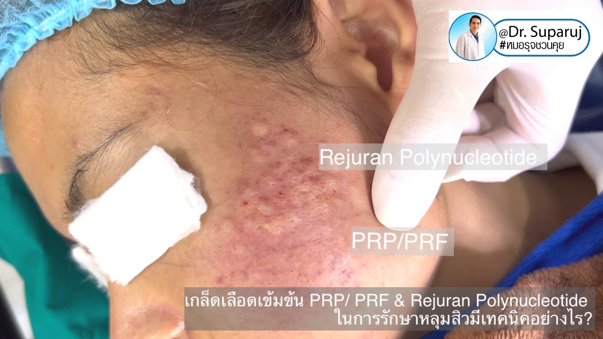 Update เทคนิคดูแลหลุมสิวด้วย Rejuran และ เกล็ดเลือดเข้มข้น PRP/PRF มีเทคนิคอย่างไร? เทคนิคไหนได้ผลดีกว่า ?