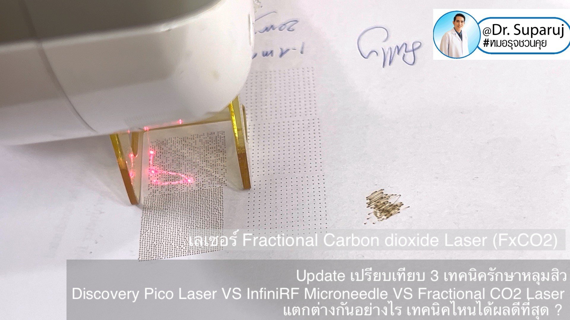 Update เปรียบเทียบ 3 เทคนิครักษาหลุมสิว Discovery Pico Laser VS InfiniRF Microneedle VS Fractional CO2 Laser แตกต่างกันอย่างไร เทคนิคไหนได้ผลดีที่สุด ?