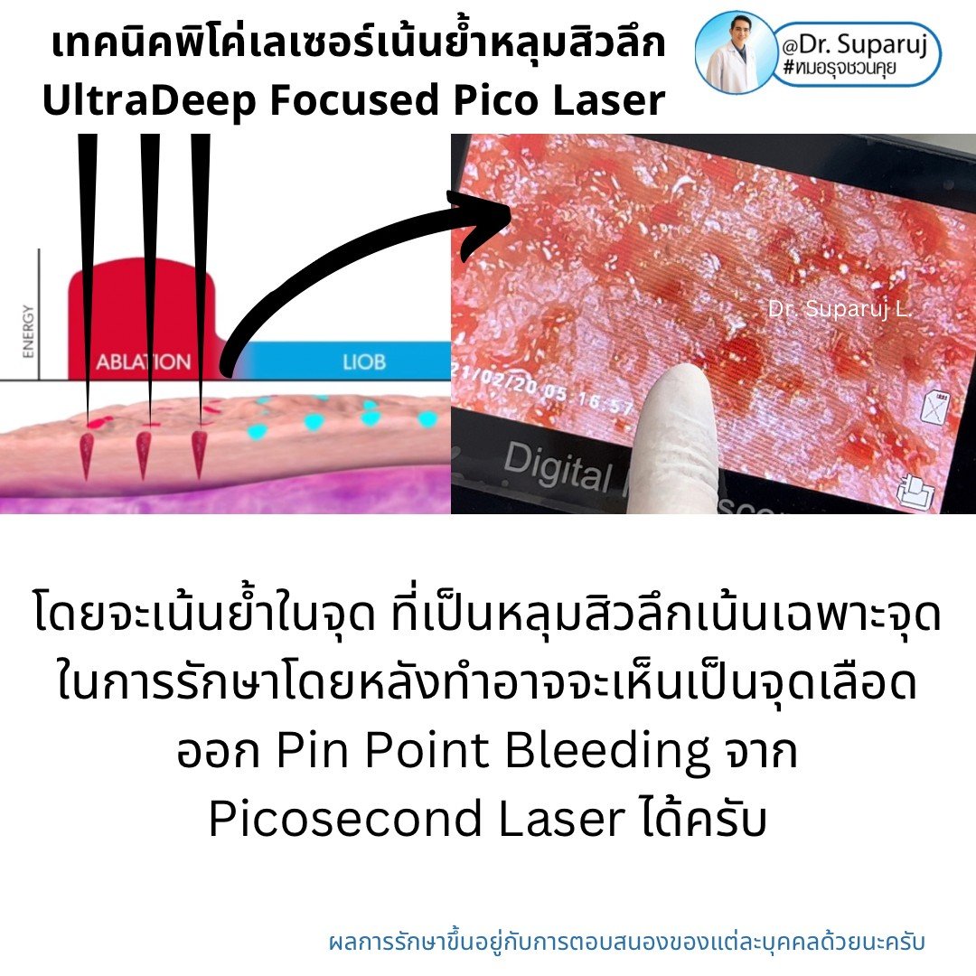 แนะนำเทคนิคดูแลหลุมสิว: เทคนิคพิโค่เลเซอร์เน้นย้ำหลุมสิวลึก UltraDeep Focused Picosecond Laser แนะนำเทคนิคดูแลหลุมสิว: เทคนิคพิโค่เลเซอร์เน้นย้ำหลุมสิวลึก UltraDeep Focused Picosecond Laser