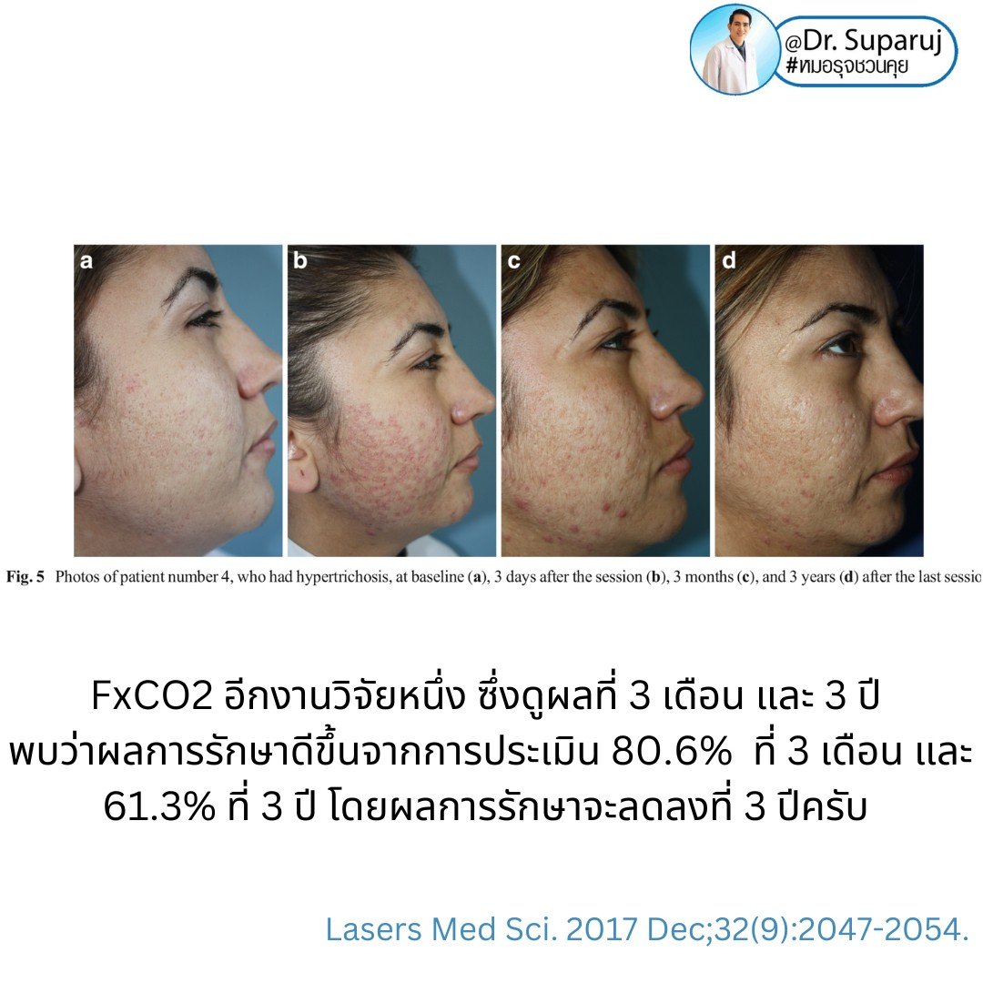 Q: หลังรักษาหลุมสิวด้วยเลเซอร์หรือเทคนิคต่างๆ หลังจากรักษาเรียบร้อยแล้ว จะมีโอกาสกลับมายุบตัว หรือหลุมสิวจะกลับมาแบบเดิมไหม? Q: หลังรักษาหลุมสิวด้วยเลเซอร์หรือเทคนิคต่างๆ หลังจากรักษาเรียบร้อยแล้ว จะมีโอกาสกลับมายุบตัว หรือหลุมสิวจะกลับมาแบบเดิมไหม?