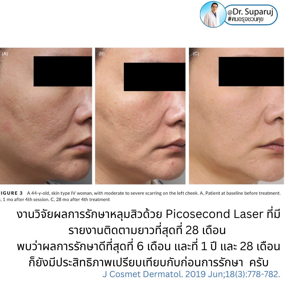 Q: หลังรักษาหลุมสิวด้วยเลเซอร์หรือเทคนิคต่างๆ หลังจากรักษาเรียบร้อยแล้ว จะมีโอกาสกลับมายุบตัว หรือหลุมสิวจะกลับมาแบบเดิมไหม? Q: หลังรักษาหลุมสิวด้วยเลเซอร์หรือเทคนิคต่างๆ หลังจากรักษาเรียบร้อยแล้ว จะมีโอกาสกลับมายุบตัว หรือหลุมสิวจะกลับมาแบบเดิมไหม?