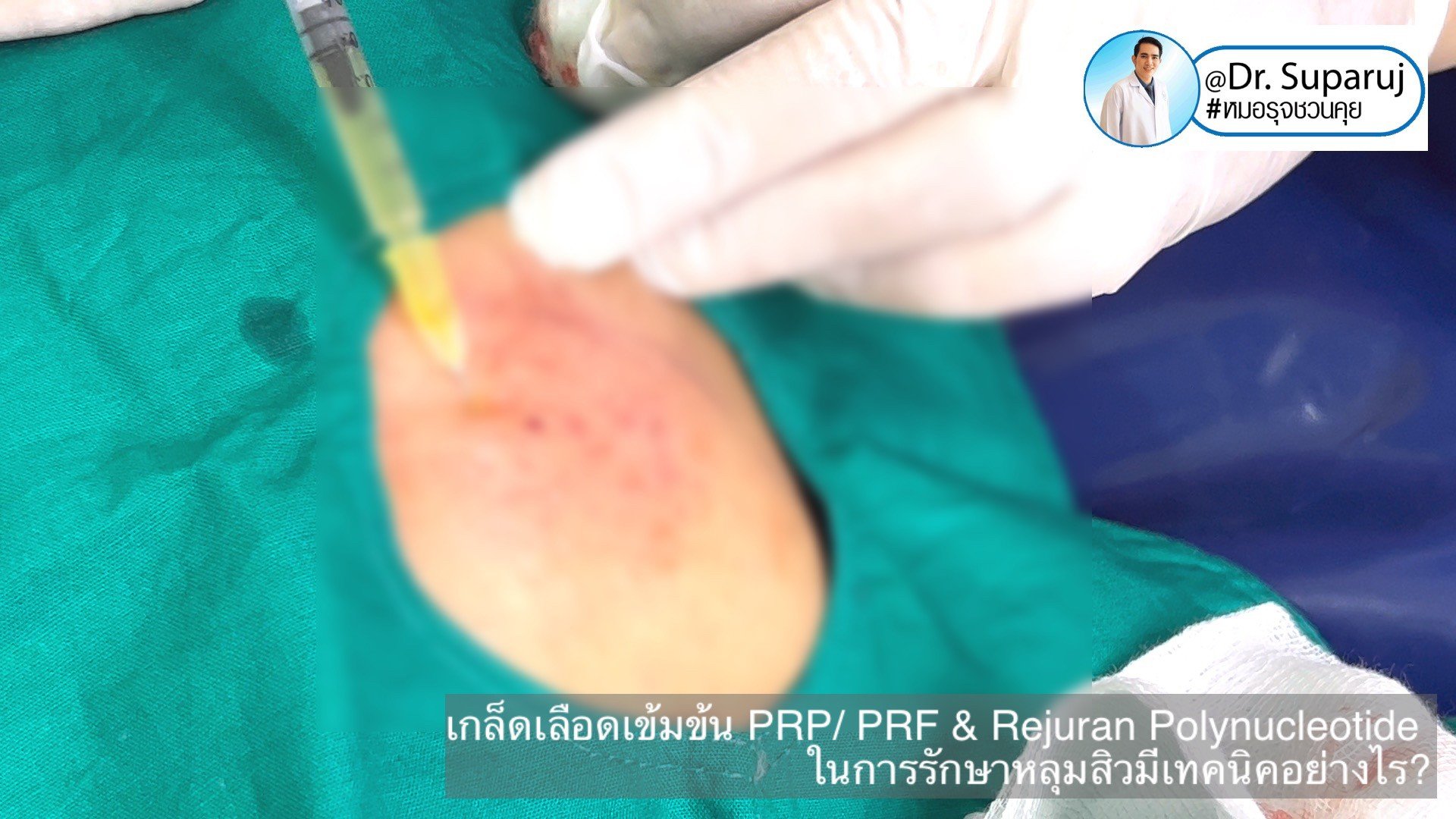 Update เทคนิคดูแลหลุมสิวด้วย Rejuran และ เกล็ดเลือดเข้มข้น PRP/PRF มีเทคนิคอย่างไร? เทคนิคไหนได้ผลดีกว่า ? Update เทคนิคดูแลหลุมสิวด้วย Rejuran และ เกล็ดเลือดเข้มข้น PRP/PRF มีเทคนิคอย่างไร? เทคนิคไหนได้ผลดีกว่า ?