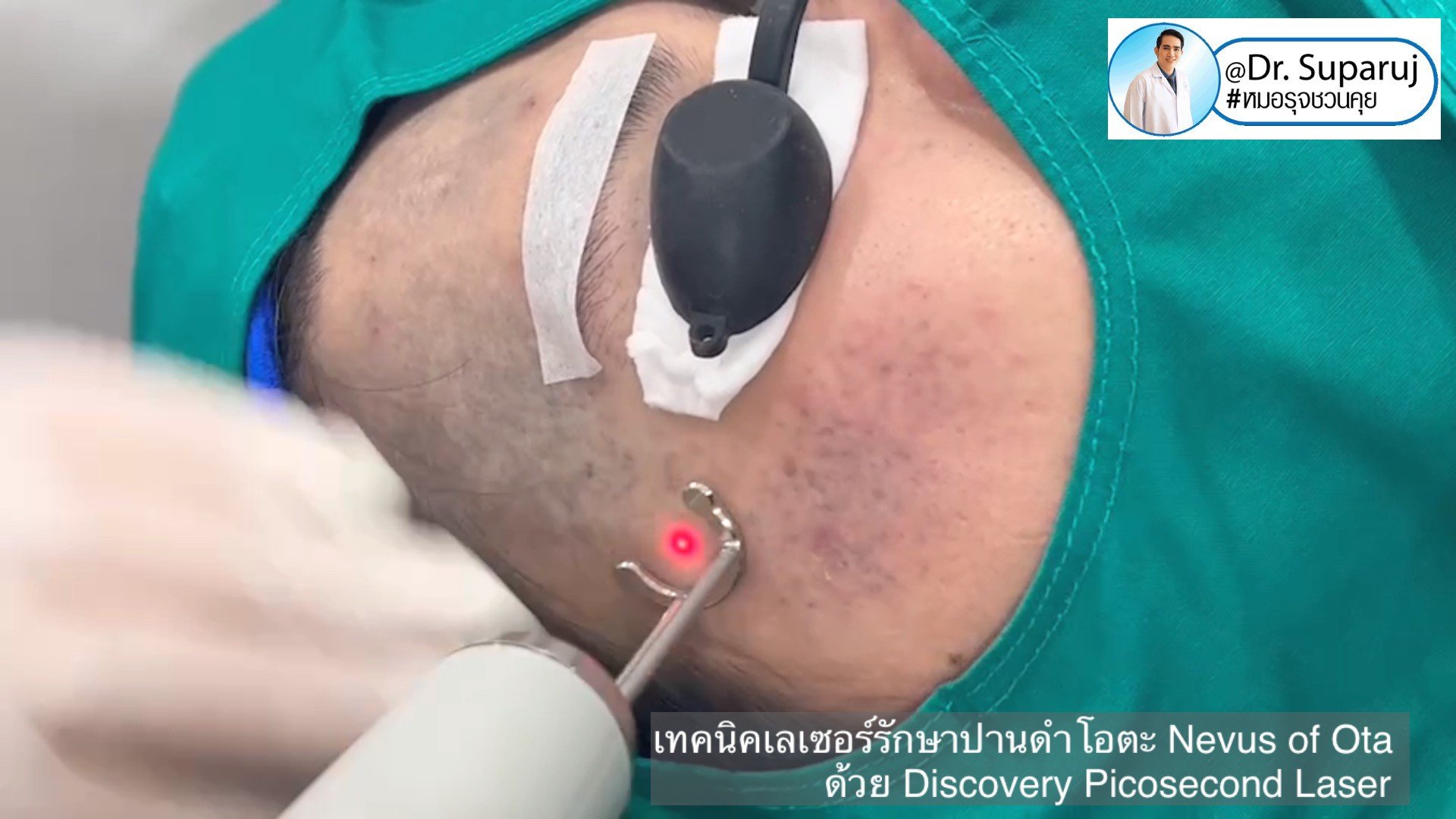 เทคนิคเลเซอร์รักษาปานดำโอตะ Nevus of Ota ด้วย Discovery Picosecond Laser เลเซอร์ปานดำ l หมอรุจชวนคุย