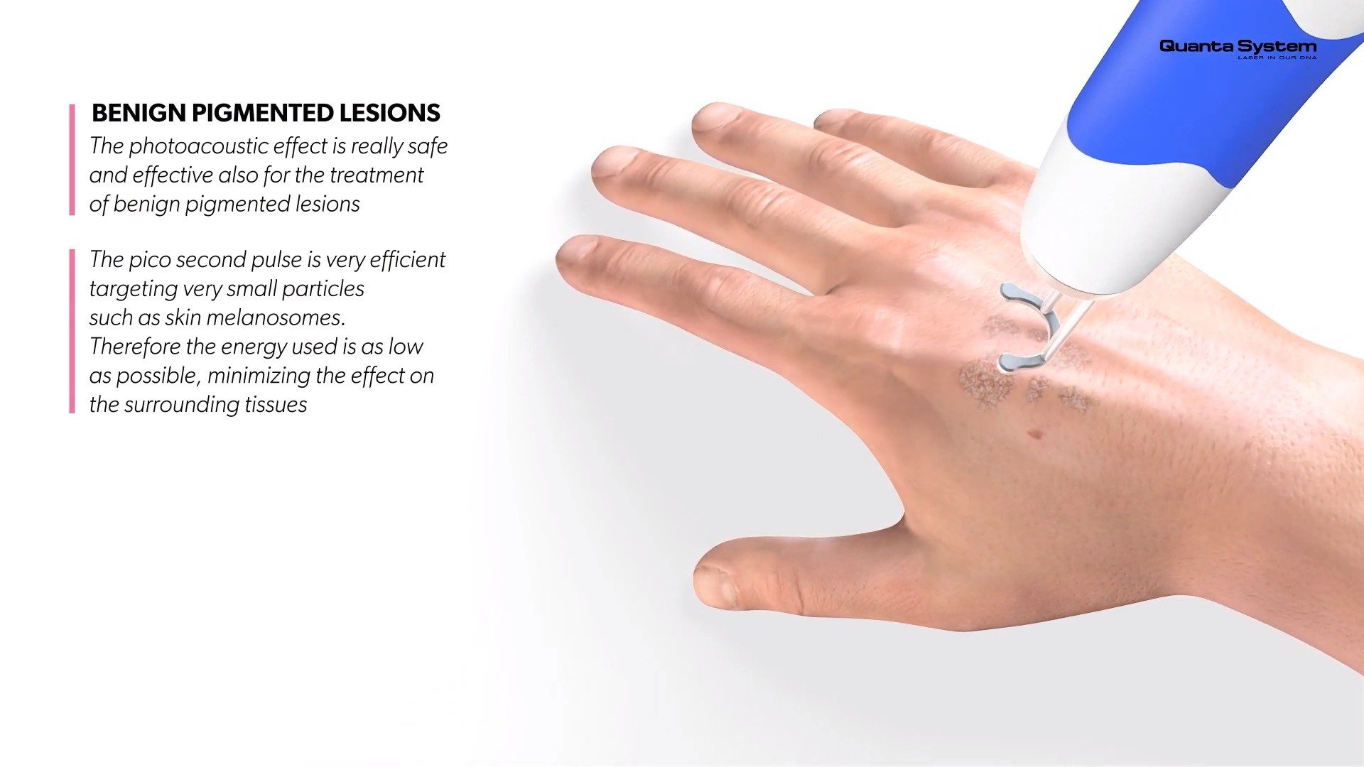 ทำความรู้จัก Discovery Pico Laser เทคนิค จุดเด่นในการดูแลรักษาปัญหาผิวหนัง หลุมสิว รูขุมขนกว้าง กระฝ้า จุดด่างดำ รอยสัก ทำความรู้จัก Discovery Pico Laser เทคนิค จุดเด่นในการดูแลรักษาปัญหาผิวหนัง หลุมสิว รูขุมขนกว้าง กระฝ้า จุดด่างดำ รอยสัก