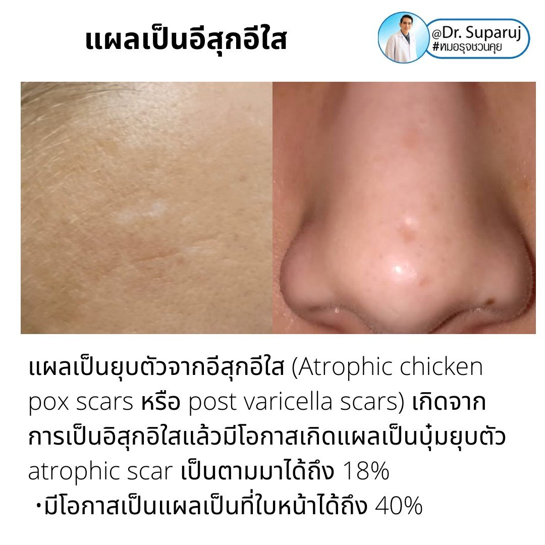 แผลเป็นยุบตัวจากอีสุกอีใส Chicken pox scars ดูแลได้อย่างไร ? แผลเป็นยุบตัวจากอีสุกอีใส Chicken pox scars ดูแลได้อย่างไร ?