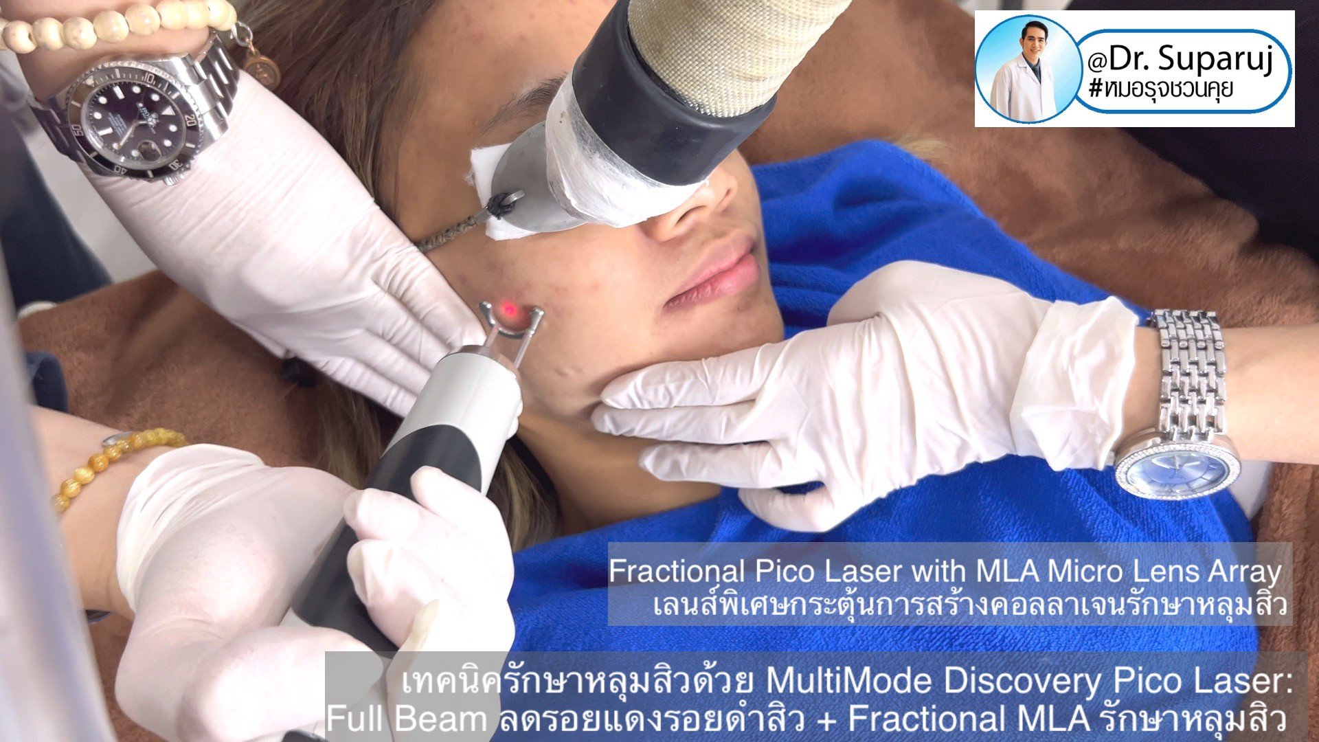 เทคนิครักษาหลุมสิวด้วย MultiMode Discovery Pico Laser: Full Beam ลดรอยแดงรอยดำสิว + Fractional MLA รักษาหลุมสิวครับ เทคนิครักษาหลุมสิวด้วย MultiMode Discovery Pico Laser: Full Beam ลดรอยแดงรอยดำสิว + Fractional MLA รักษาหลุมสิวครับ