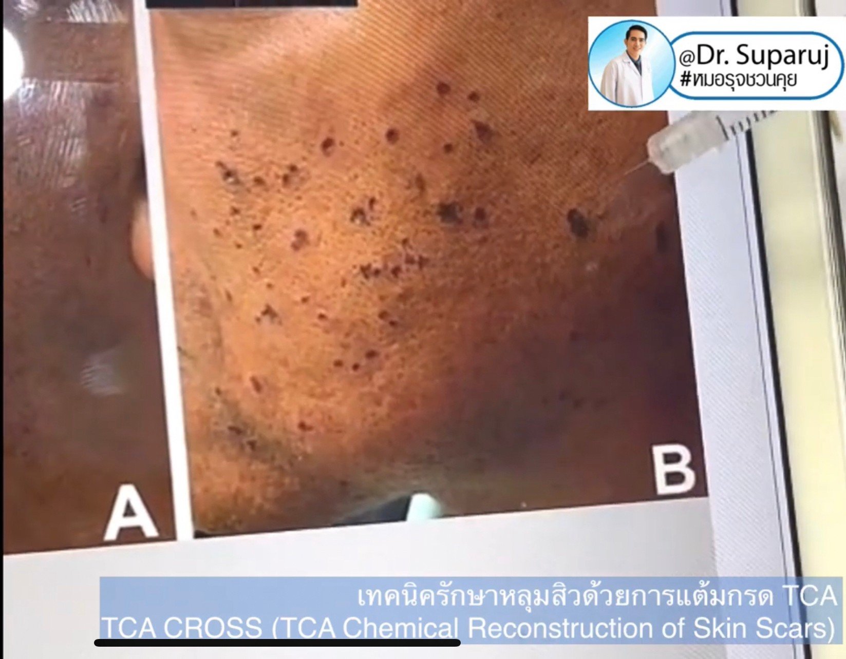 รักษาหลุมสิวด้วยการแต้มกรด TCA แล้วเกิดเป็นรอยดำ เกิดจากอะไรได้บ้าง? รักษาหลุมสิวด้วยการแต้มกรด TCA แล้วเกิดเป็นรอยดำ เกิดจากอะไรได้บ้าง?