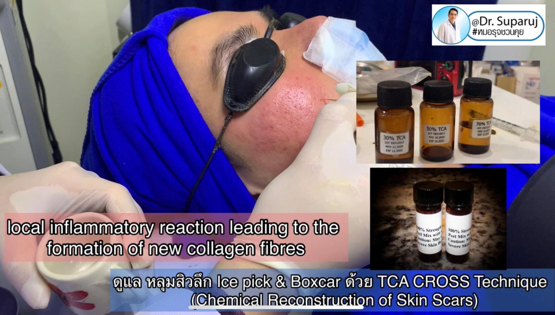 รักษาหลุมสิวด้วยการแต้มกรด TCA แล้วเกิดเป็นรอยดำ เกิดจากอะไรได้บ้าง? รักษาหลุมสิวด้วยการแต้มกรด TCA แล้วเกิดเป็นรอยดำ เกิดจากอะไรได้บ้าง?