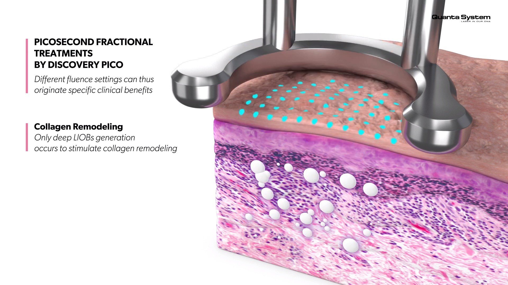 ทำความรู้จัก Discovery Pico Laser เทคนิค จุดเด่นในการดูแลรักษาปัญหาผิวหนัง หลุมสิว รูขุมขนกว้าง กระฝ้า จุดด่างดำ รอยสัก ทำความรู้จัก Discovery Pico Laser เทคนิค จุดเด่นในการดูแลรักษาปัญหาผิวหนัง หลุมสิว รูขุมขนกว้าง กระฝ้า จุดด่างดำ รอยสัก