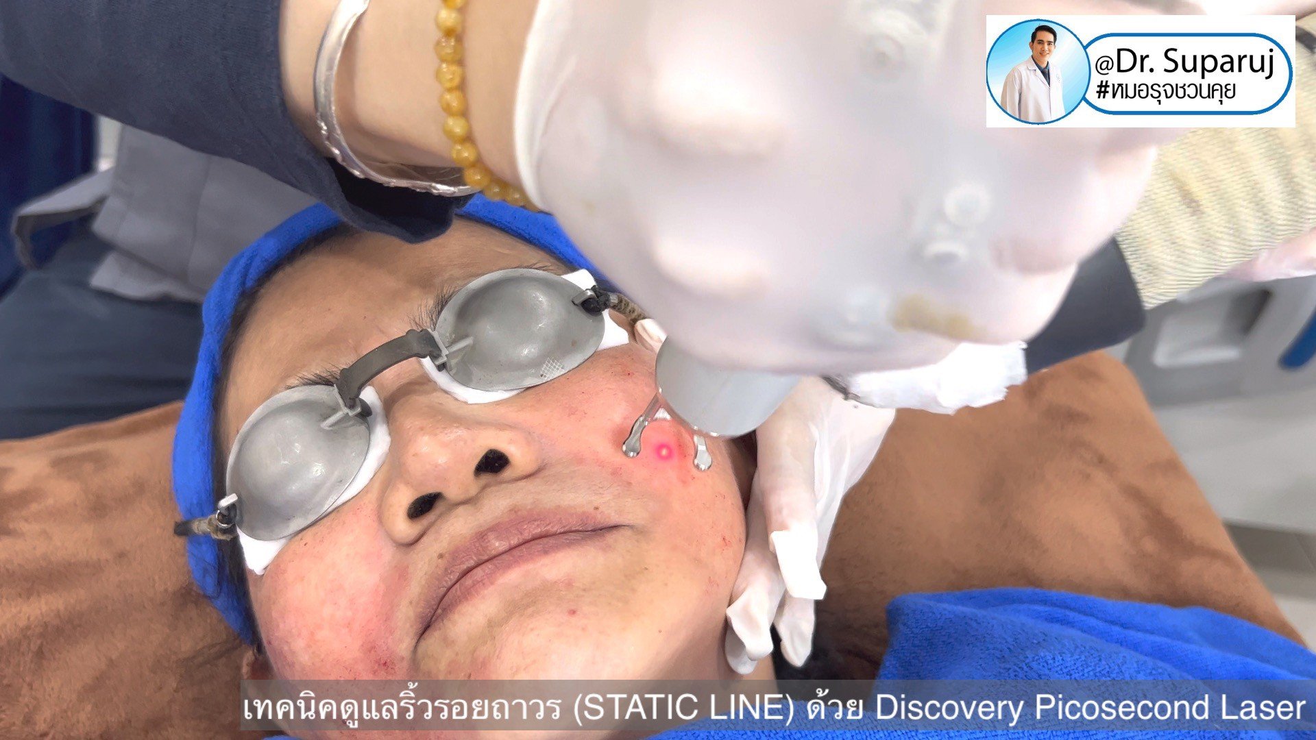 เทคนิคดูแลริ้วรอยถาวร (STATIC LINE) ด้วย Discovery Picosecond Laser