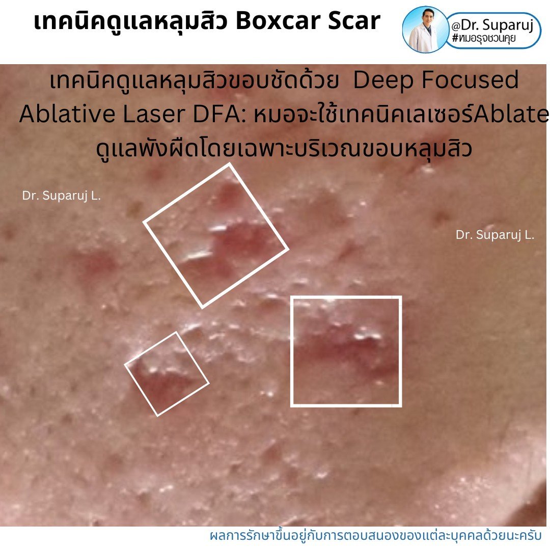 แนะนำเทคนิคดูแลหลุมสิว: เทคนิค Deep Focused Ablative Laser (DFA) ดูแลหลุมสิวลึกขอบชัดพังผืดหนา Boxcar Scar และหลุมสิวลักษณะเส้นยาว Linear scar แนะนำเทคนิคดูแลหลุมสิว: เทคนิค Deep Focused Ablative Laser (DFA) ดูแลหลุมสิวลึกขอบชัดพังผืดหนา Boxcar Scar และหลุมสิวลักษณะเส้นยาว Linear scar