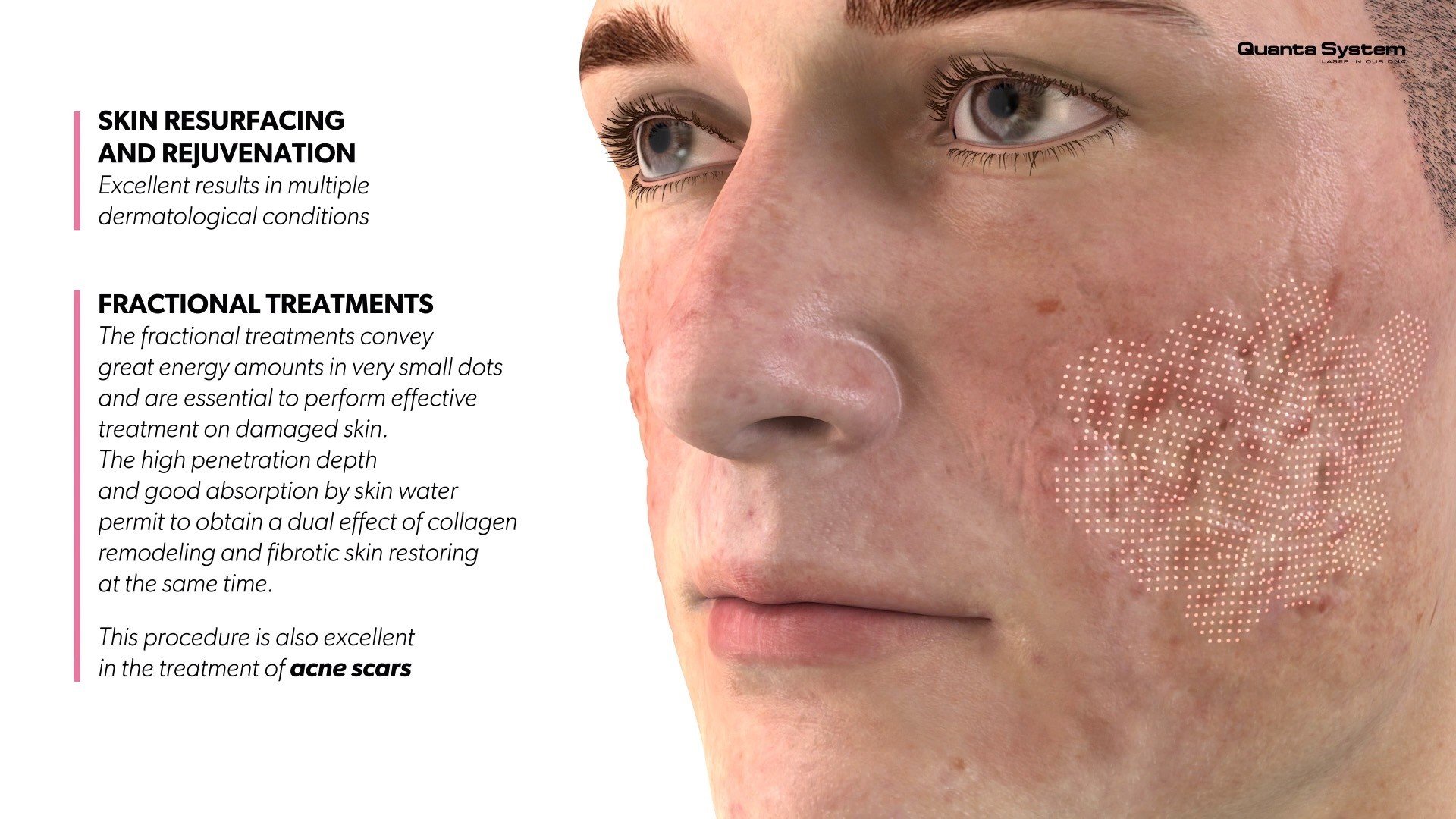 ทำความรู้จัก Discovery Pico Laser เทคนิค จุดเด่นในการดูแลรักษาปัญหาผิวหนัง หลุมสิว รูขุมขนกว้าง กระฝ้า จุดด่างดำ รอยสัก ทำความรู้จัก Discovery Pico Laser เทคนิค จุดเด่นในการดูแลรักษาปัญหาผิวหนัง หลุมสิว รูขุมขนกว้าง กระฝ้า จุดด่างดำ รอยสัก