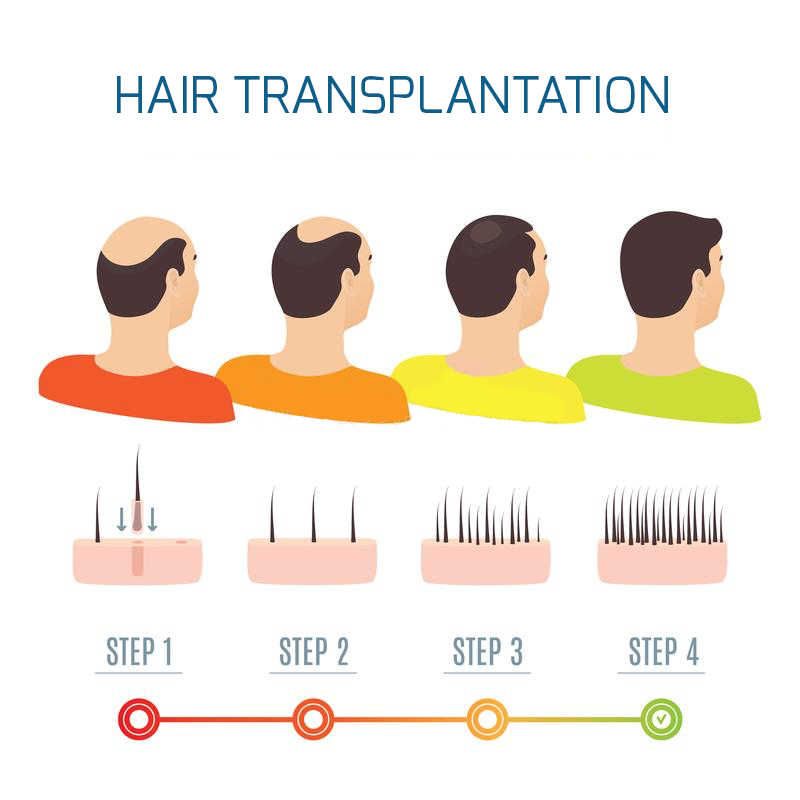 การปลูกผม (Hair Transplantation) คืออะไร การปลูกผม (Hair Transplantation) คืออะไร