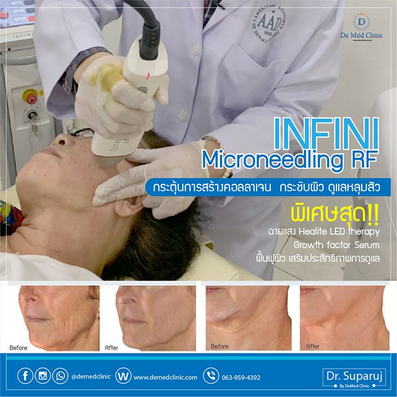 INFINI Microneedling RF กระตุ้นการสร้างคอลลาเจน กระชับผิว ดูแลหลุมสิว แผลเป็น