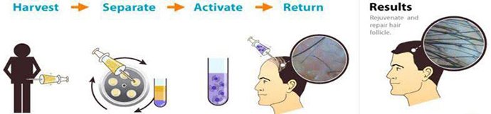 ดูแลผมร่วง ผมบางด้วย Regenera Hair Stem Cell Therapy !! ดูแลผมร่วง ผมบางด้วย Regenera Hair Stem Cell Therapy !!
