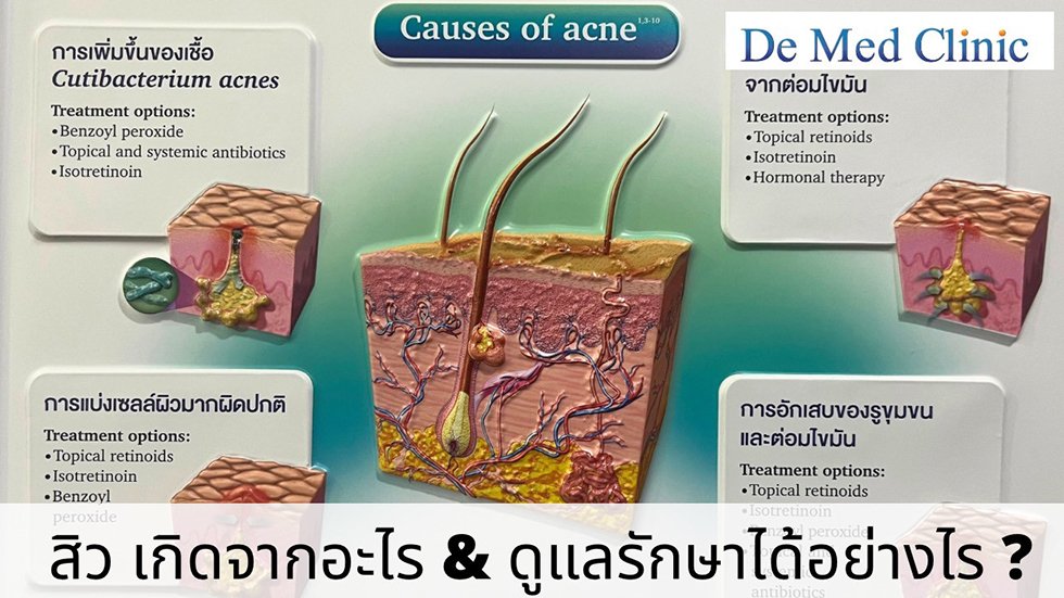 สิว เกิดจากอะไร & ดูแลรักษาได้อย่างไร ?