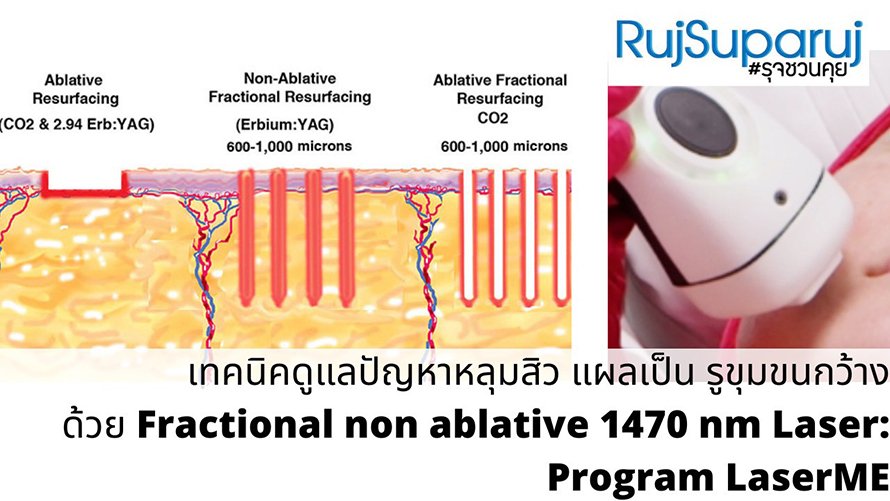 เทคนิคดูแลปัญหาหลุมสิว ด้วย Fractional non ablative 1470 nm Laser: Program LaserME