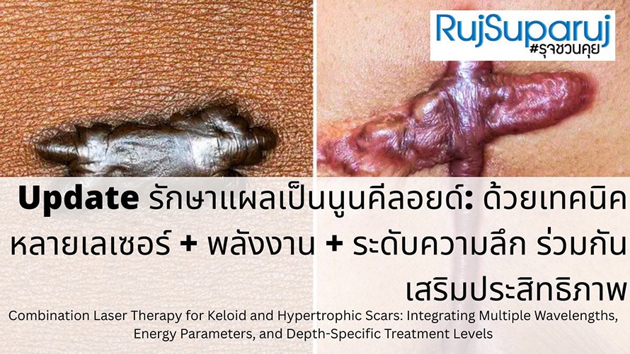 Update รักษาแผลเป็นนูนคีลอยด์: ด้วยเทคนิคหลายเลเซอร์ + พลังงาน + ระดับความลึก ร่วมกันเสริมประสิทธิภาพ Combination Laser Therapy for Keloid and Hypertrophic Scars: Integrating Multiple Wavelengths, Energy Parameters, and Depth-Specific Treatment Level