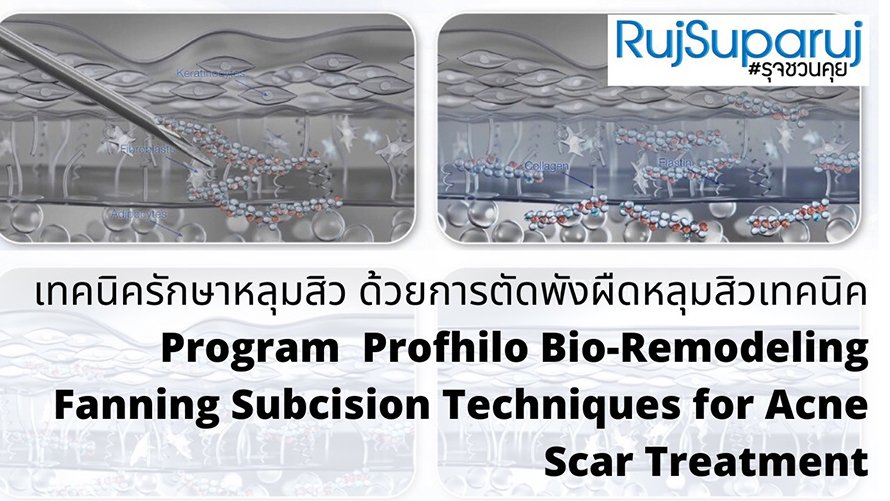เทคนิครักษาหลุมสิว ด้วยการตัดพังผืดหลุมสิวเทคนิค Program Profhilo Bio-Remodeling Fanning Subcision Techniques for Acne Scar Treatment