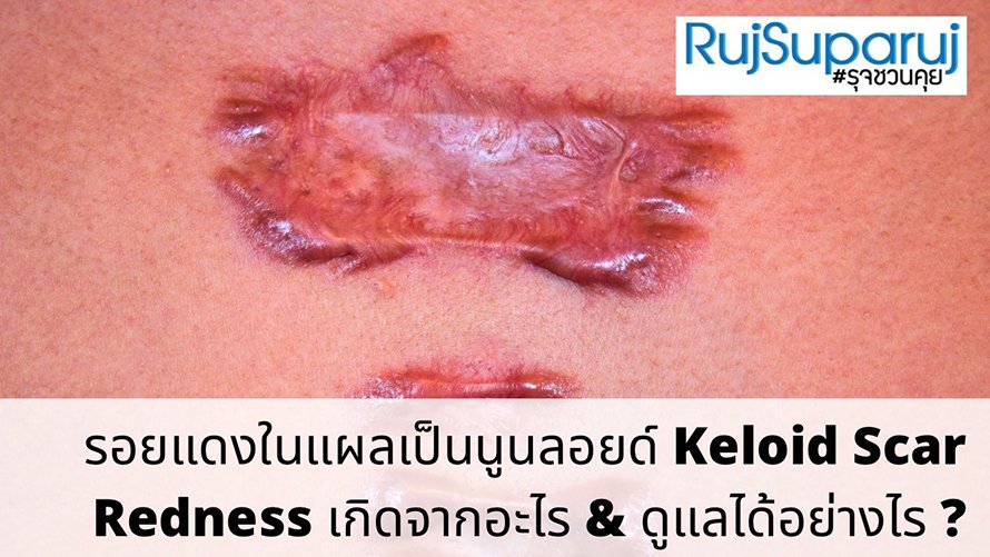 รอยแดงในแผลเป็นนูนลอยด์ Keloid Scar Redness เกิดจากอะไร & ดูแลได้อย่างไร ?