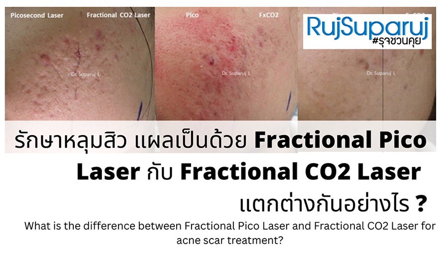 เจาะลึกความแตกต่าง: Fractional CO2 vs Fractional Picosecond Laser ในการรักษาหลุมสิว