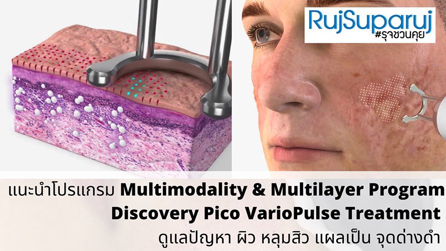 แนะนำโปรแกรม Multimodality & Multilayer Program Discovery Pico VarioPulse Treatment ดูแลปัญหาผิว หลุมสิว แผลเป็น จุดด่างดำ
