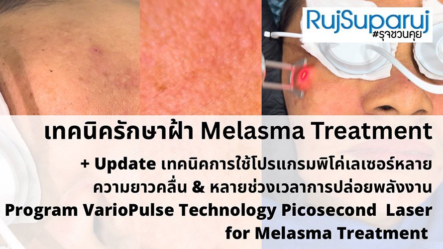 Update เทคนิคดูแลปัญหาฝ้า Melasma Treatment Update